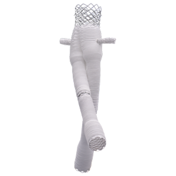 开窗腹主动脉覆膜支架系统